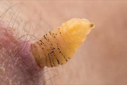 Researcher Raises Botflies Under Skin: asset-mezzanine-16x9