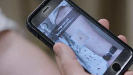 Using Artificial Intelligence to Diagnose Melanoma: asset-mezzanine-16x9